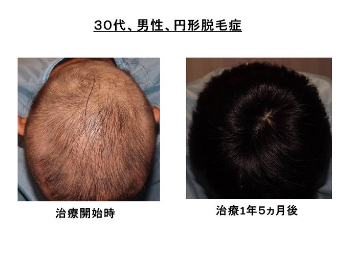 円形脱毛症　病院""